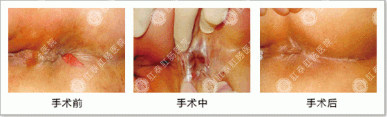 SFT肛泰方法(第三代HCPT)治肛裂过程