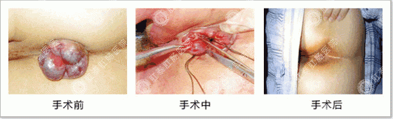 环状混合痔外切内扎手术