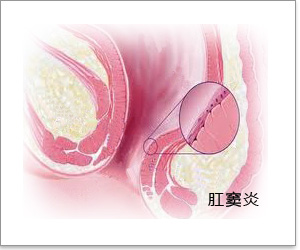 肛窦炎示意图