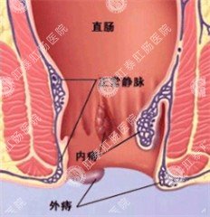 肛门有肉疙瘩是怎么回事