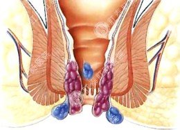 先天性肛瘘的症状和治疗