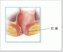 男性肛瘘多发的原因是什么？