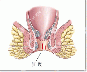 肛裂手术后注意事项有哪些_医博医院