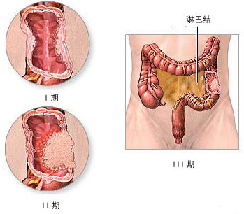 结肠状