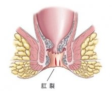 福州女人治疗肛裂好的医院在哪