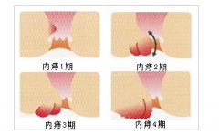 福州哪家医院治疗内痔疮
