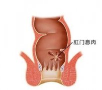 福州治疗肛门息肉去哪家医院