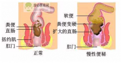 福州便秘专业医院