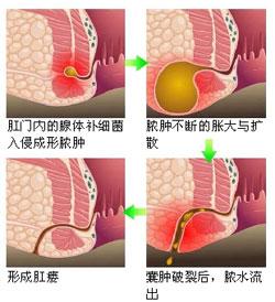 福州肛瘘医院