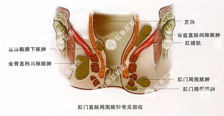 福州屁股附近又红又肿是怎么了？