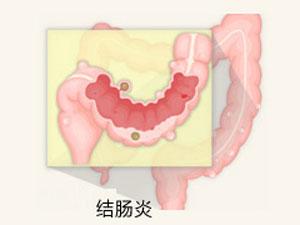 福州哪些方法能检查结肠炎?