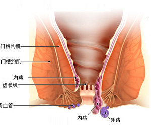 为什么会得炎性外痔