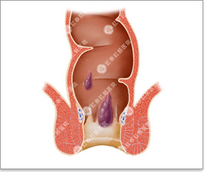 肛门异物可能是哪些病